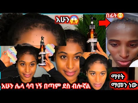 🛑ፀጉሬ፣ ፊቴ የ5 ወር ለውጥ አሁን ሌላ ሳባ ሆኛለሁ😱