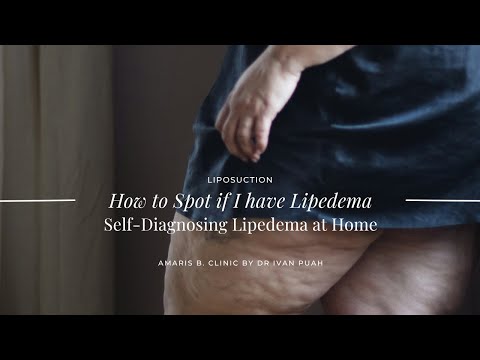 How to Spot if I have Lipedema? Self-Diagnosing Lipedema at Home | Amaris B. Clinic by Dr Ivan Puah