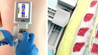 VerTouch spinal fracture imaging technology by IntuiTap - 3D animation