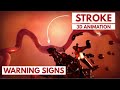 Understanding Strokes and FAST Test
