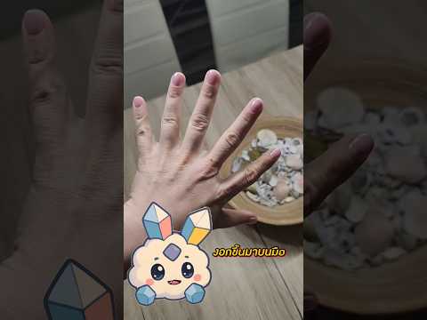 ปรากฏการณ์นิ้วงอก! มีนิ้วมือมากกว่า 10 นิ้ว