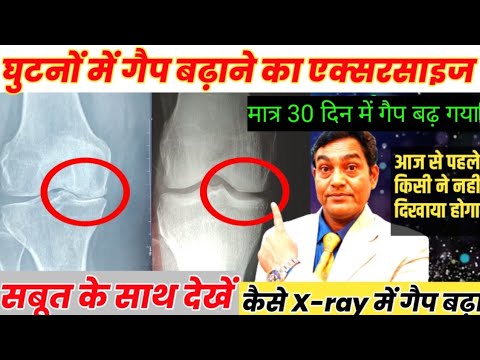 Knee Gap Exercises in hindi | Osteoarthritis Grade 4 से नॉर्मल हो गया |दर्द ख़तम |गैप भी बढ़ गया |