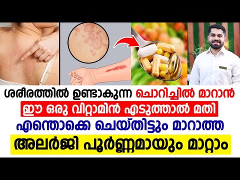 അലര്ജി എന്തൊക്കെ ചെയ്തിട്ടും മാറുന്നില്ലേ | ഈ ഒരു വിറ്റാമിന് എടുത്താൽ അലര്ജി പൂർണമായി മാറും |ALLERGY