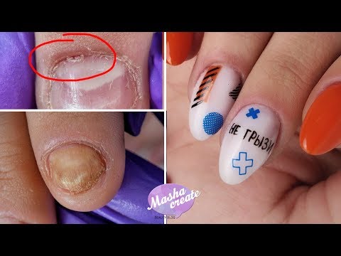 Куча ногтевых Болячек 😰 Ногти ГРЫЗУНА! Онихомадезис, сложный маникюр. Наращивание ОБКУСАННЫХ ногтей