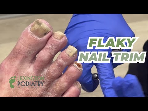 Freels vs. Fungus | Flaky Nail Trim