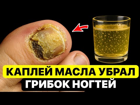 Дерматолог: капнул и грибок отходит вместе с салфеткой! А если МАСЛО СМЕШАТЬ с...