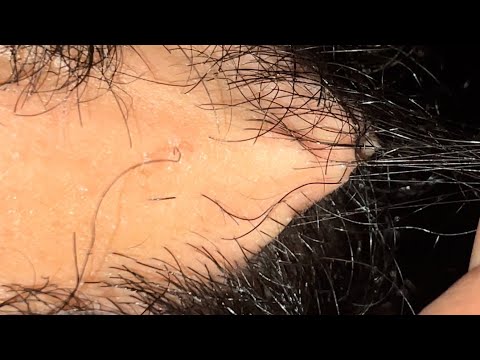 ODDLYSATISFYINGVIDEO HAIR REMOVAL INGROWN HAIR SATISFYING ASMR VIDEO 209 