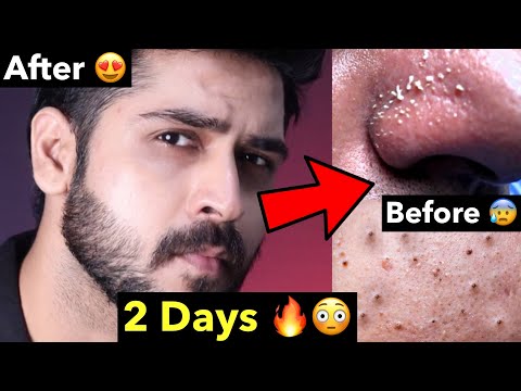 Remove Blackheads, Whiteheads Naturally From Face | How to Remove Whiteheads, Blackheads at Home