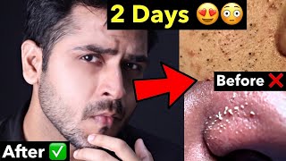 Simple Tips to Remove Blackheads and Whiteheads from Face and Nose