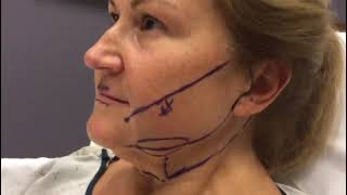 Full Face Transformation! Lower Facelift, Buccal Fat Removal, and Fat Transfer to Lips