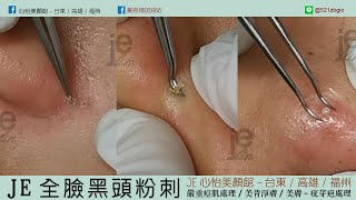 JE全臉大黑頭無痛針清-16歲男學生 #台東心怡美顏館 #全省je加盟店