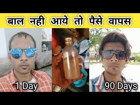 Best hair oil for hair growth | बाल नहीं आए तो पैसे वापस? 110% गारेंटी | hair growth oil