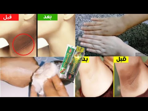 تخجلين من سواد العنق واليدين والمنطقة الحساسةبهذا المكون السحري تخلصي منسواد20عام نتيجة في فيديو
