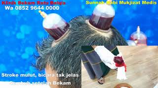 Bekam yg benar Stroke,Hipertensi dan Kolesterol