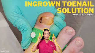 Ingrown Removal by MissFootFixer