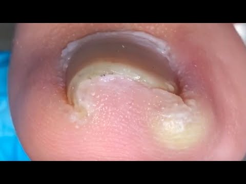 Ingrown Toenails Hurt Your Toenails, Remove The Nails【Crazy pedicure room】