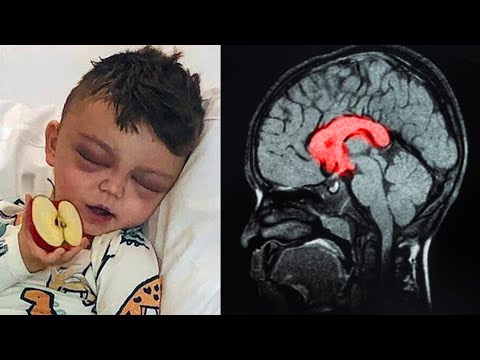 Toddler Gets Brain Damage After Eating Slice Of Apple – Mom Sends A Warning To All