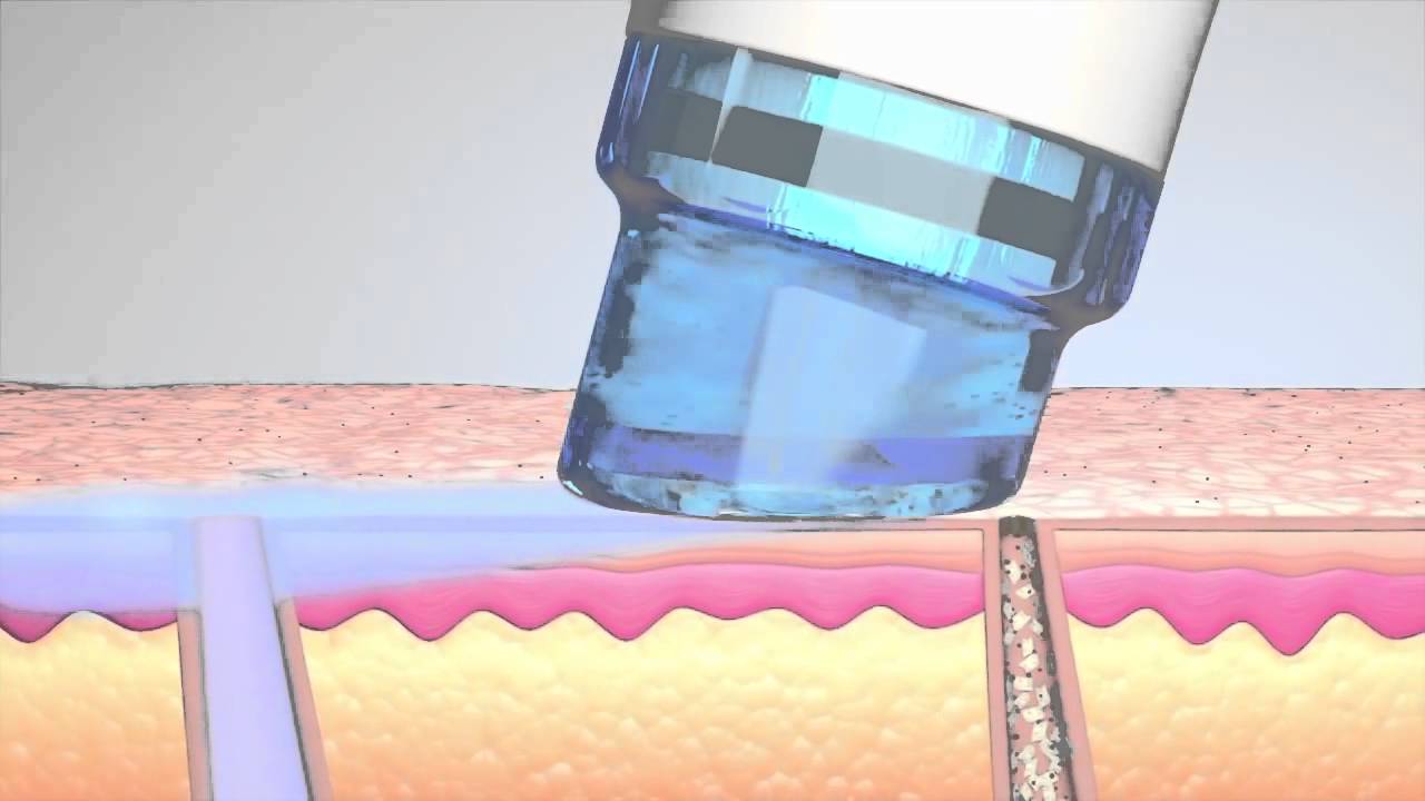 Microneedling device approaching skin surface layer.