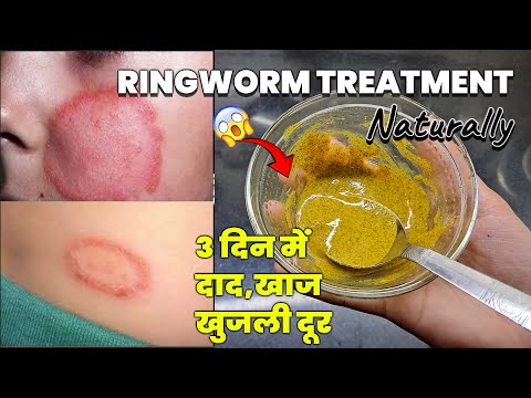 सिर्फ 3 दिन में पुराने दाद, खाज, खुजली को दूर करने का सबसे सफल उपाय | Ringworm Treatment Naturally