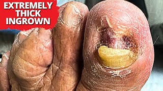 Deep, Thick Ingrown Nail Removal –SO Satisfying To Watch!