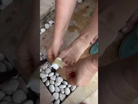 Убираем быстро грибок ногтя!