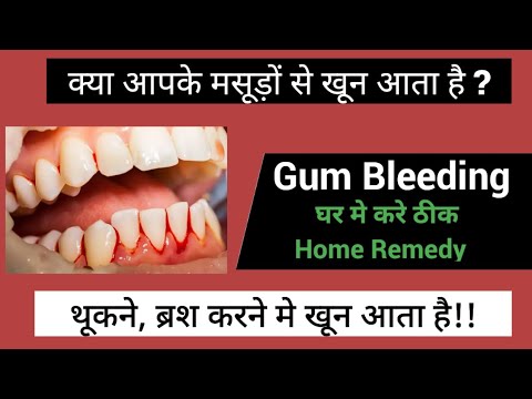 Bleeding gums treatment & home remedy