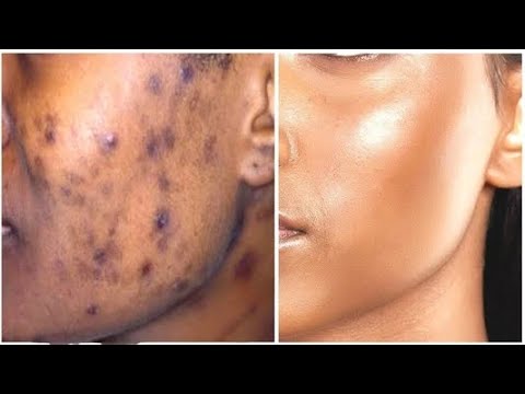 पुराने से पुराने दागधब्बे व किसी भी तरह के निशान हटाने का अचूक उपाय | Remove Dark spots, Chicken pox