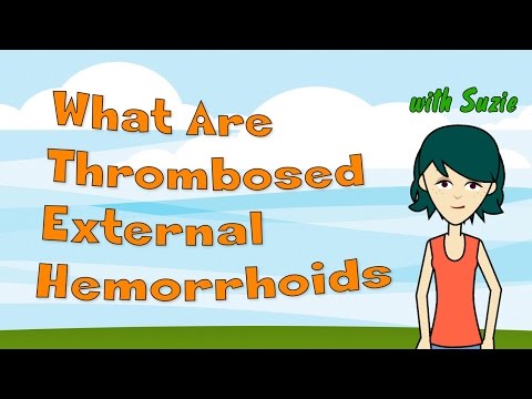 What Are Thrombosed External Hemorrhoids? The Facts