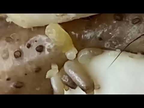 Blackheads & Whiteheads Satisfying Removal @0376