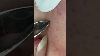 Satisfying nose blackheads removal. Credit goes pureskin.beautyspa on TikTok