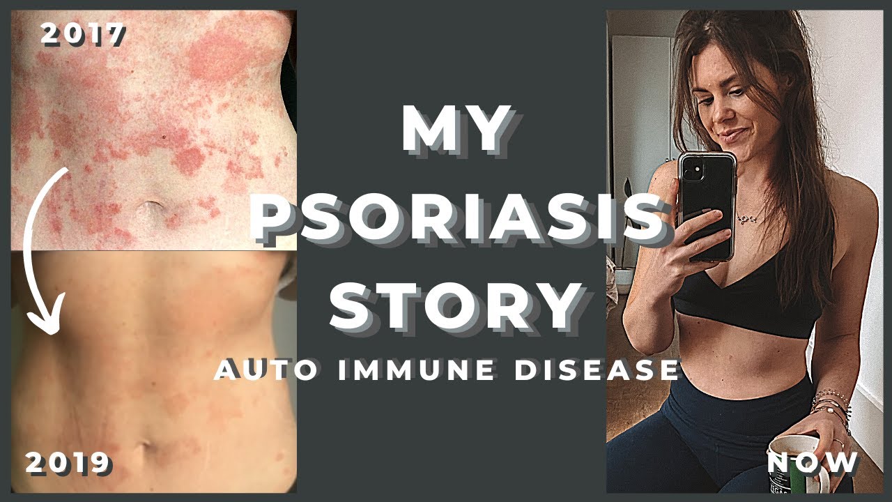 Psoriasis - How I Deal With and Manage Autoimmune Disease (Diet, Treatment, Body Confidence)