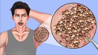 ASMR - 여드름 피부 관리 애니메이션 - Infected Underums hair removal Treatment skin care - #asmr #asmranimation