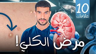 10 أعراض لقصور الكلى يمكنك رؤيتها !
