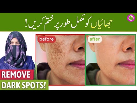 Muh Par Nishan Hatane Ka Tarika | Jhaiyon Ka Mukamal Ilaj