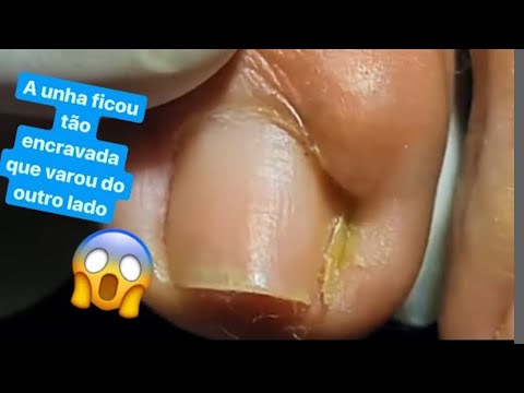 FICOU MUITOS ANOS SEM DESENCRAVAR A UNHA DEU NISSO 😷😱 Podologia Podologo Maurelio