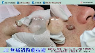 JE臉頰皮下囊腫處理 #林季儀老師 #JE美容創業加盟招募中
