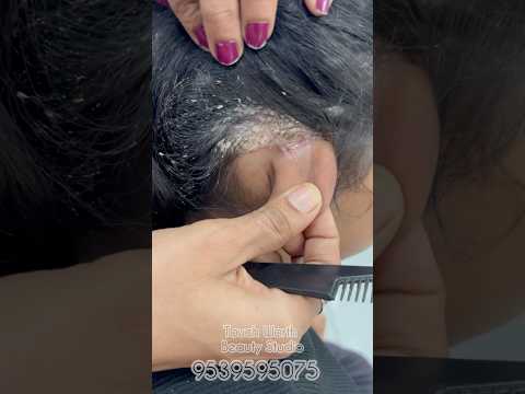 ഇതെന്താണ് 🙄 അറിയുന്നവർ കമന്റ്‌ ചെയൂ...ഇങ്ങനെ ഒരു അവസ്ഥ ഒരു കുഞ്ഞിനും വരാണ്ടിരിക്കട്ടെ 🥹🥺  #hair