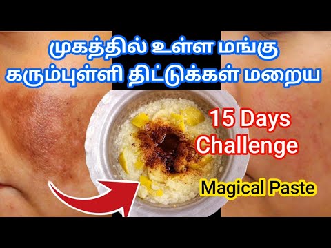 Magical Home remedy To Treat Malasma, Darkspot And Pigmentation/ இது ஒரு Best Home Remedies