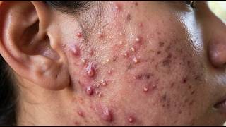 Loan Nguyen Acne Treatment 18zz