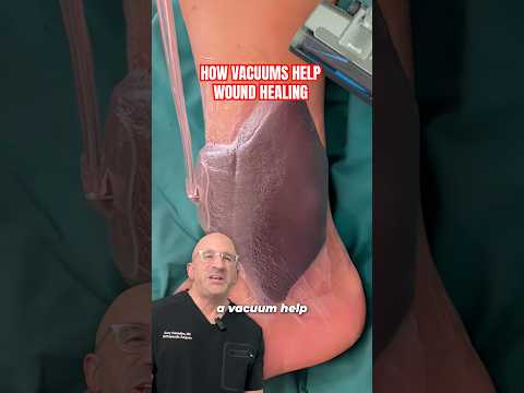 Heal Your Wounds 80% FASTER with Vacuum Wound Therapy