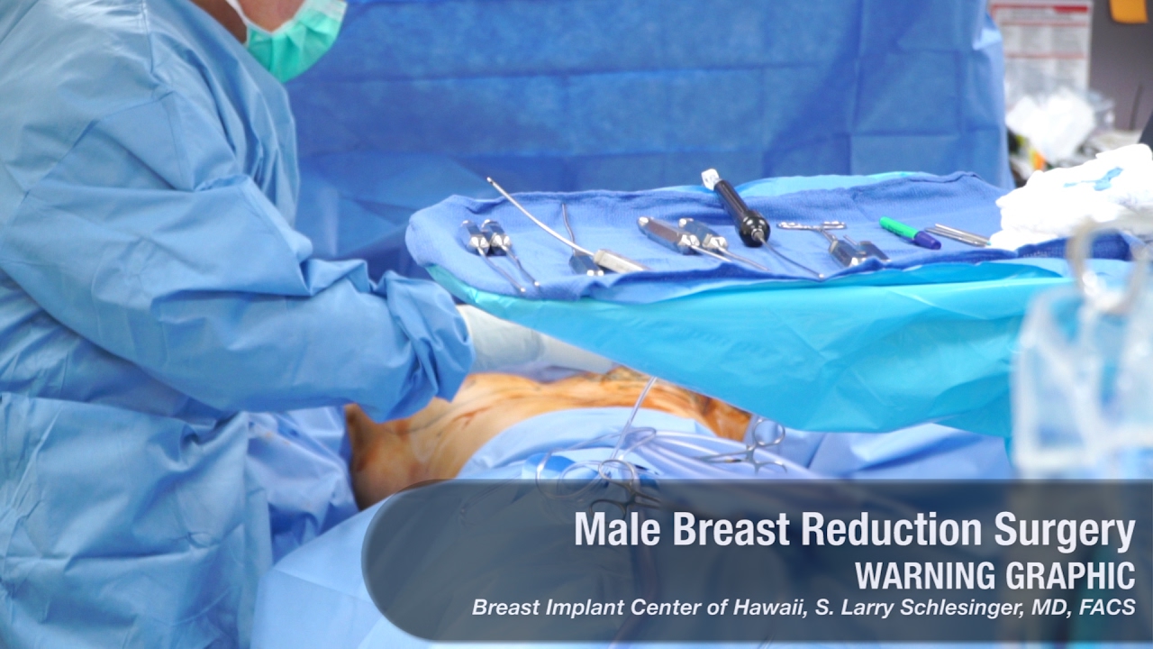 Male Breast Reduction (Man Boob) Surgery - GRAPHIC. Award-Winning Plastic Surgeon - Breast Implant Center of Hawaii