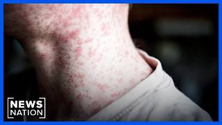 YouTube video thumbnail: Measles Cases Reach Highest Level in U.S. Since 1991