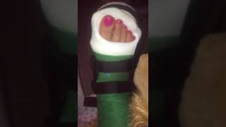 New cast! Green cast with Pink Glitter Oct 2019
