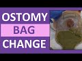 Ostomy Bag Change Procedures and Techniques