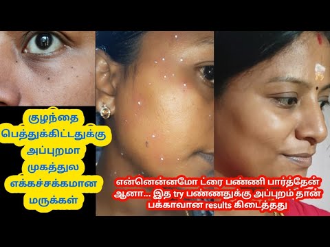 😱இது ஒன்னு போதும் வெறும் 3 நாள்ல முகத்தில் உள்ள மொத்த மருவும் காலி🔥/ How To Remove Warts/ Skin warts