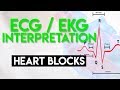 Understanding Heart Blocks and ECG Patterns