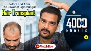 4290 Grafts Hair Transplant in Surat | Amazing Results & Affordable Cost in Surat #hairtransplant