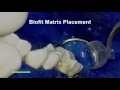 Modern Cavity Preparations and Techniques