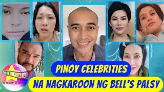 Pinoy Celebrities na nagkaroon ng Bell's Palsy