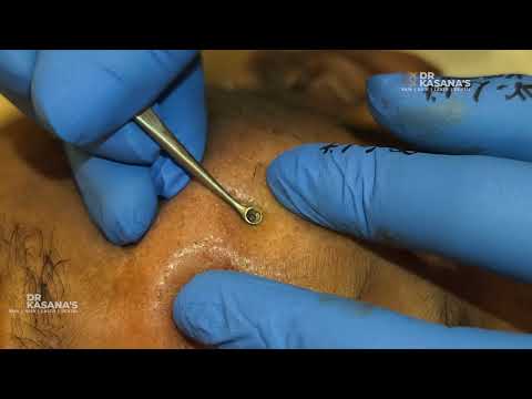 Dr. Kasana's Shocking Blackhead Removal SECRET!